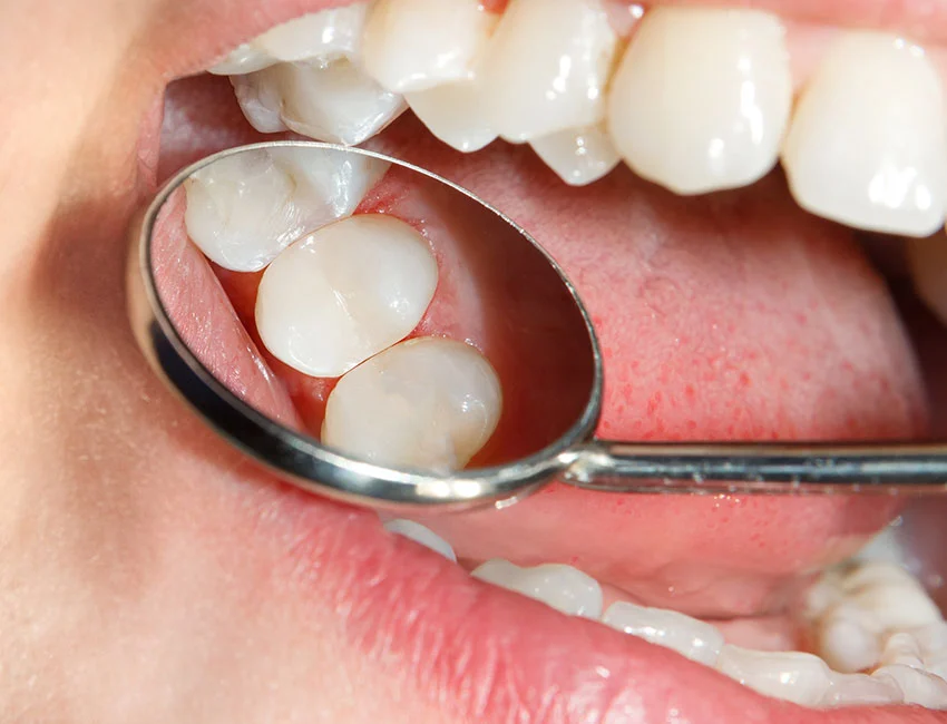 Signs you may need dental fillings — Canyon Country Dental Care