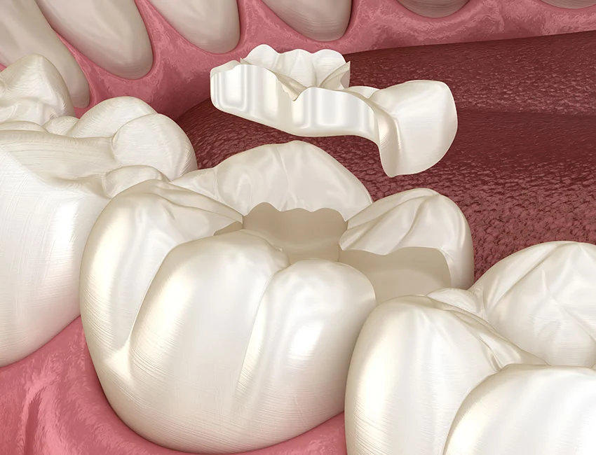 Signs you may need dental inlays and onlays — Canyon Country Dental Care