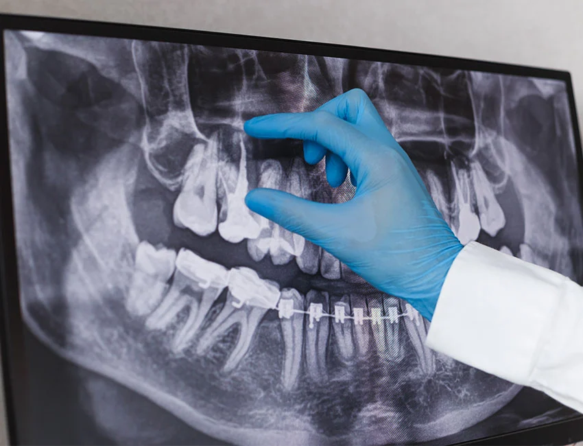 Signs you may need root canal — Canyon Country Dental Care
