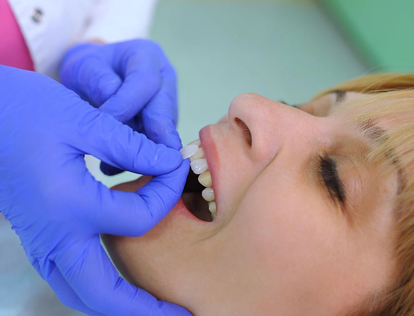 Porcelain Veneers at Canyon Country Dental Care
