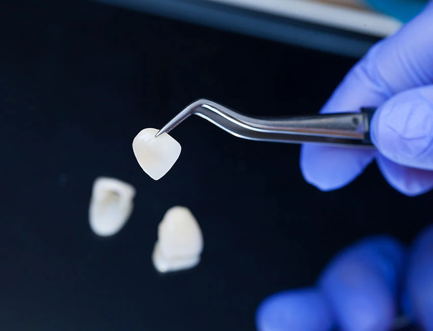 Porcelain Veneers in Canyon Country, CA