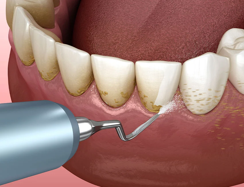 Dental Cleaning at Canyon Country Dental Care
