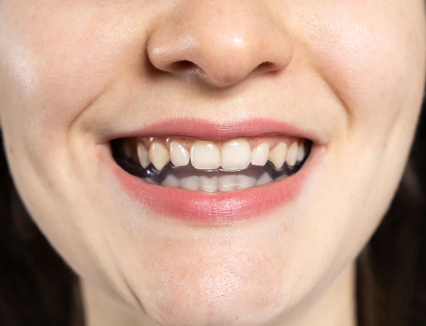 TMJ Treatment at Canyon Country Dental Care