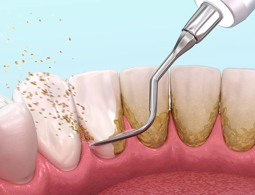 Signs you may need periodontal care — Canyon Country Dental Care