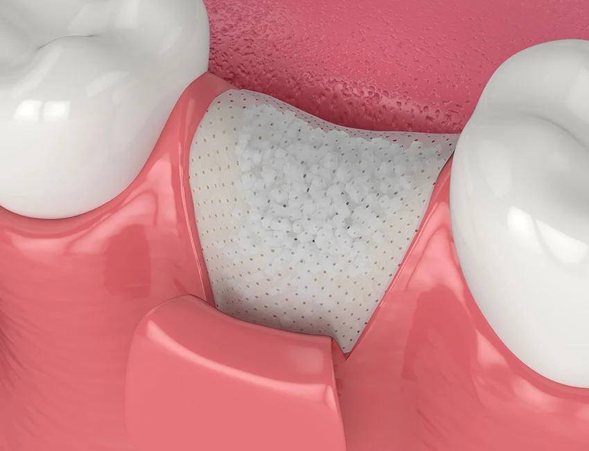 Bone Grafting at Canyon Country Dental Care