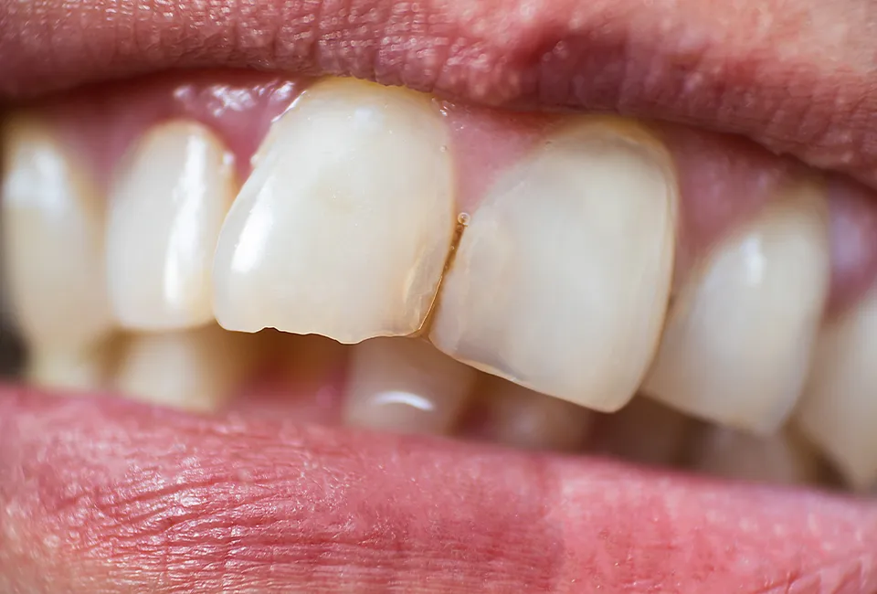 chipped teeth