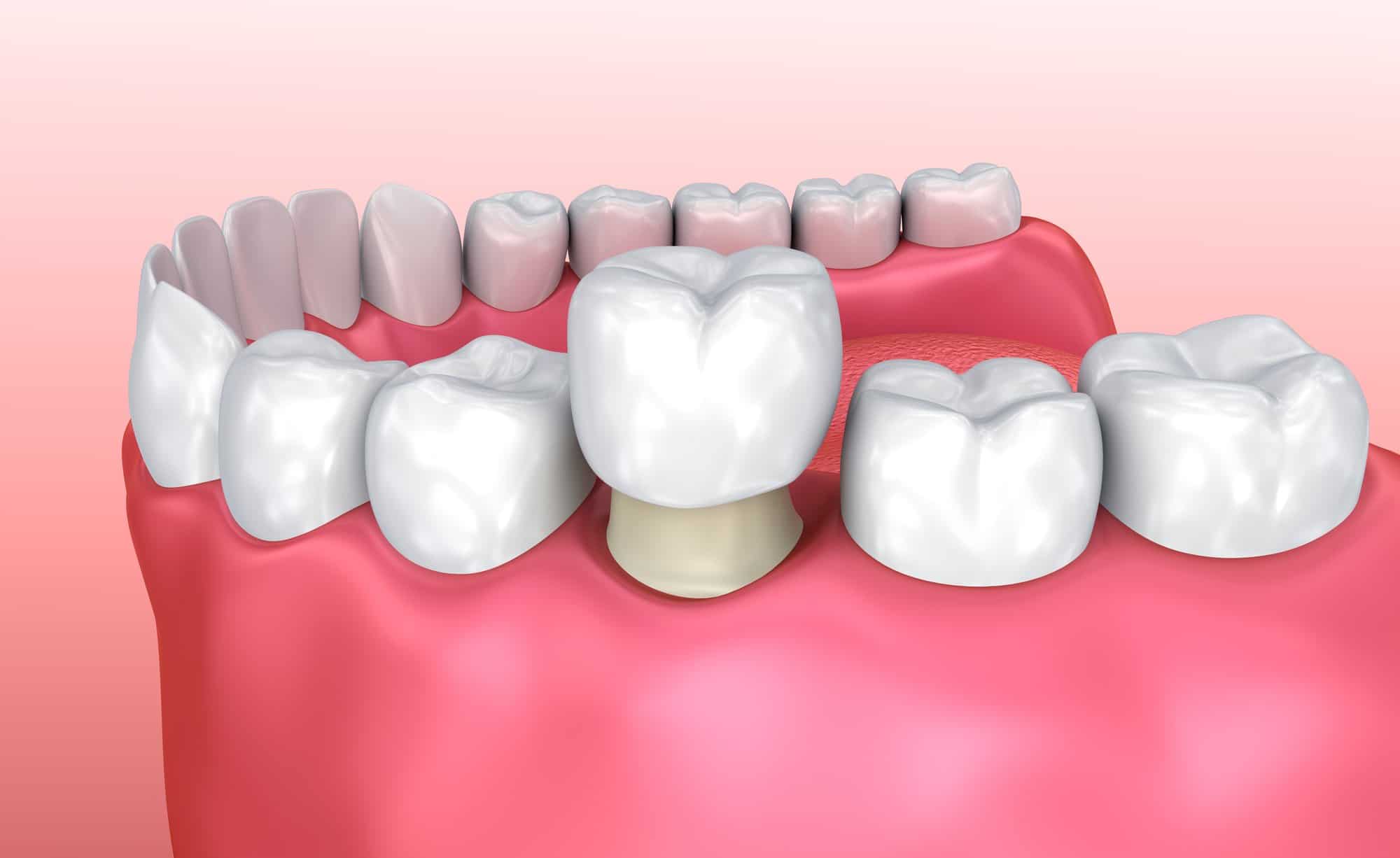 dental crowns for cracked tooth