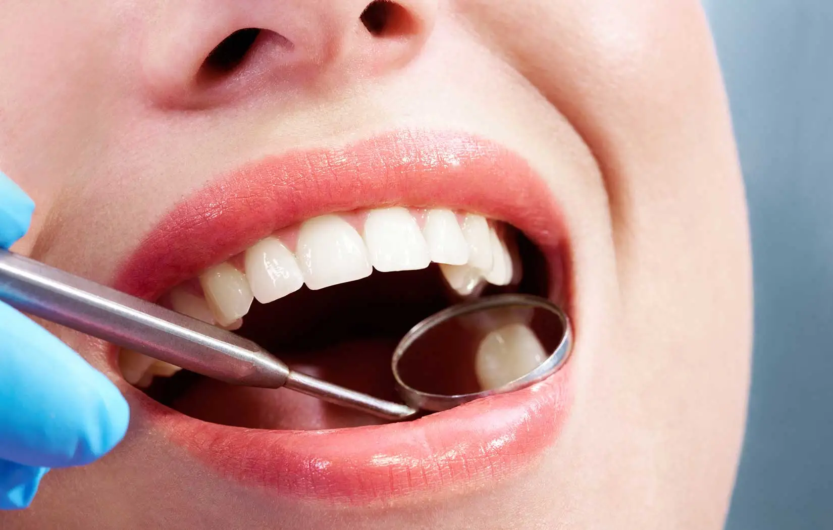 fluoride treatments