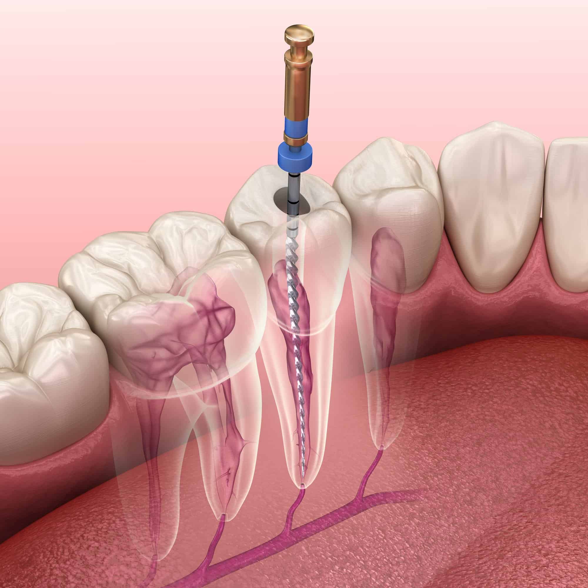 root canal example