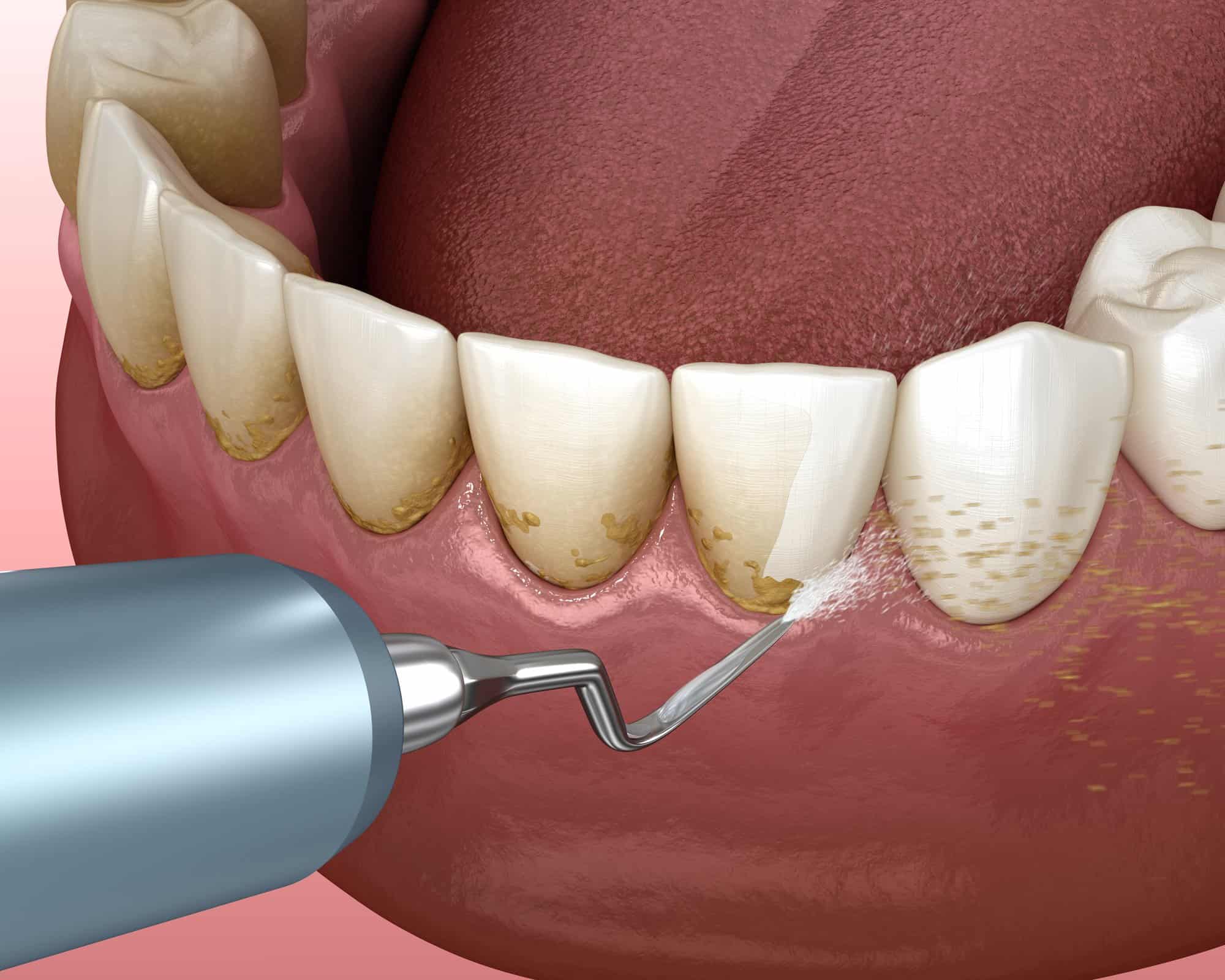 teeth cleaning procedure