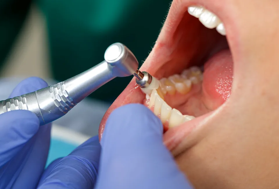 Teeth cleaning in Canyon Country, CA